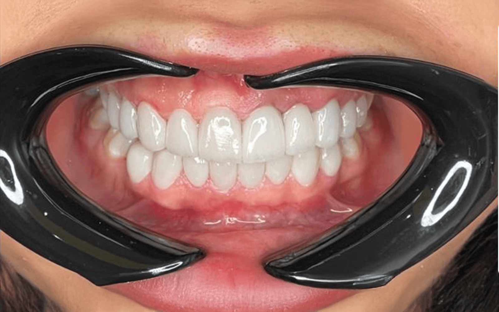 After dental treatment smile - Teeth Whitening