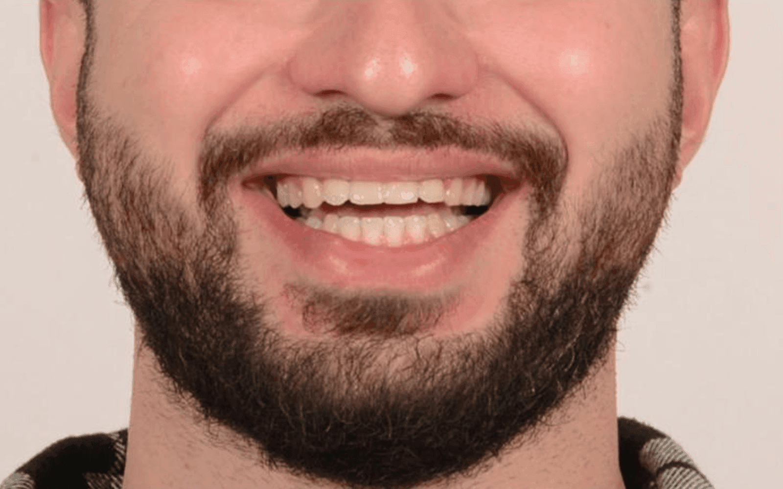 After dental treatment smile - Veneers