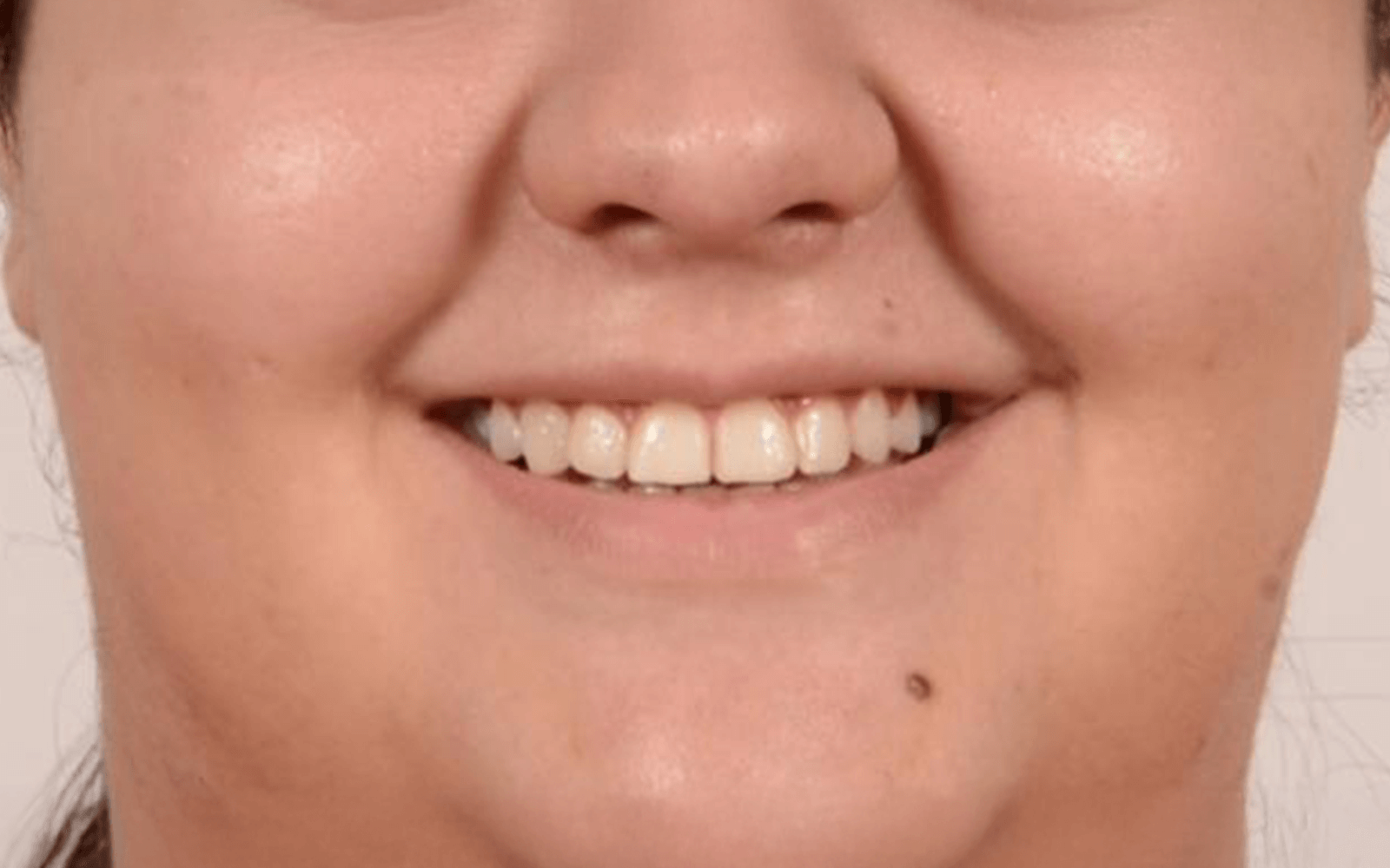 After dental treatment smile - Invisalign Treatment